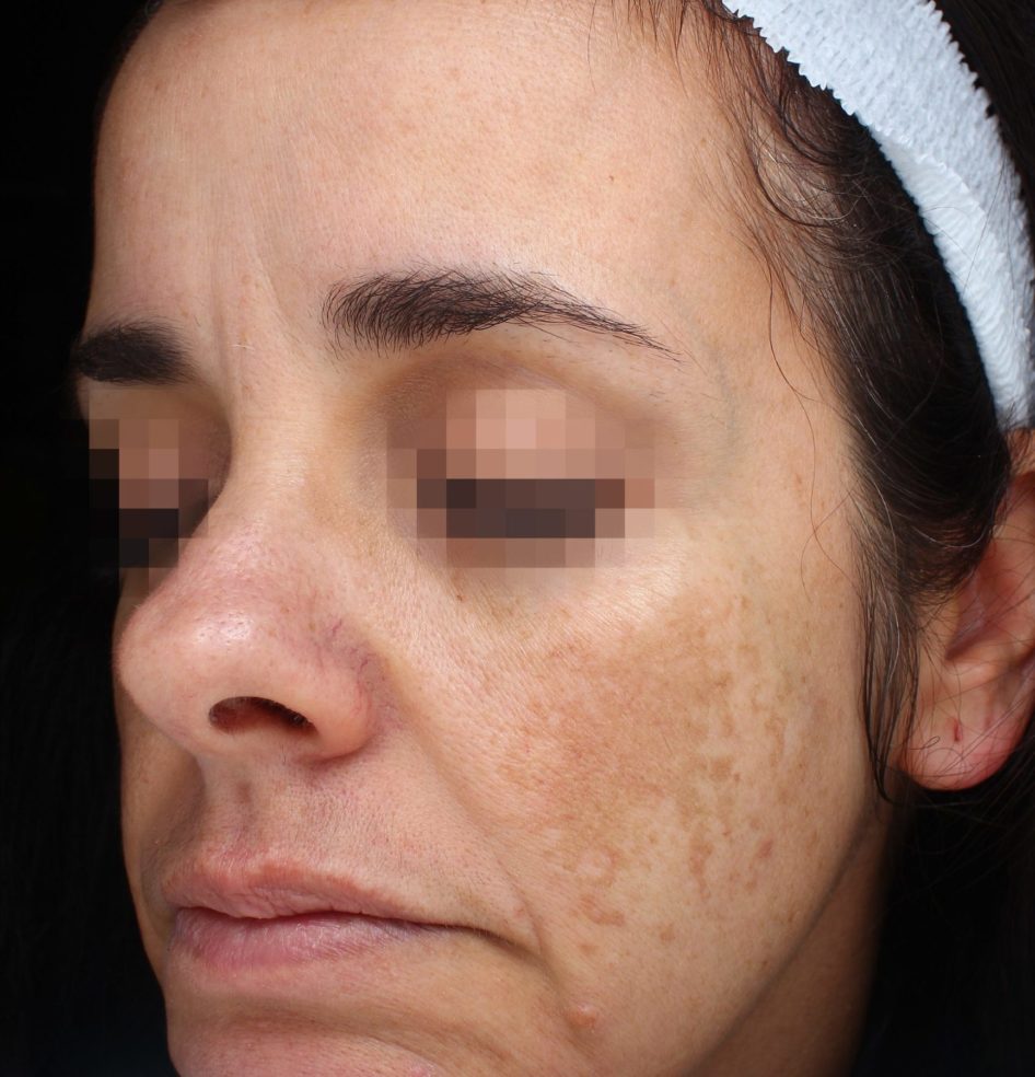 prd_4844_picosure-pro-before-after-photo-dr-weiss-copy-2