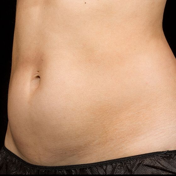 sculpsure a zsírvesztéshez hővel)