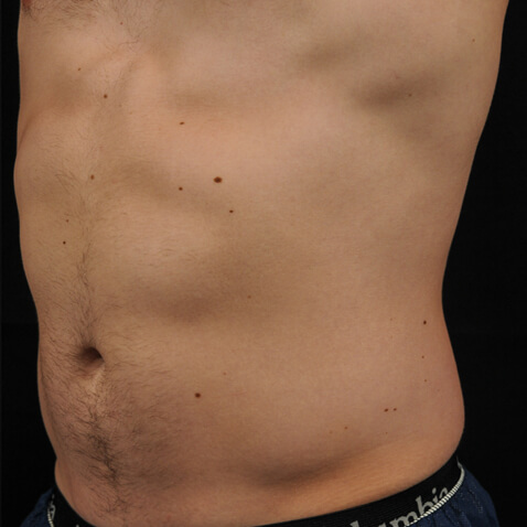 accufit_ba_1_after_lutronic_research_clinic