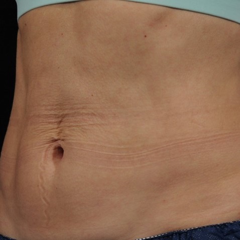 accufit_ba_2_after_lutronic_research_clinic