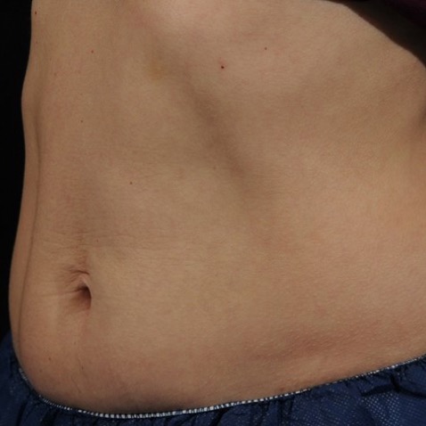 accufit_ba_2_before_lutronic_research_clinic