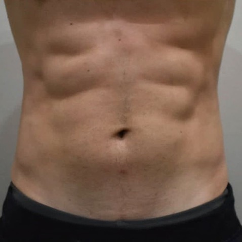 accufit_ba_after_1_warsaw_body_sculpting