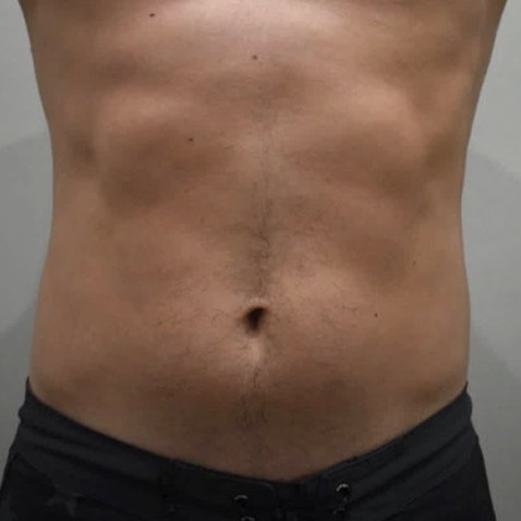 accufit_ba_before_1_warsaw_body_sculpting