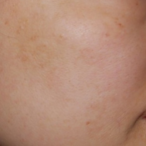 c2_ba_toning_after